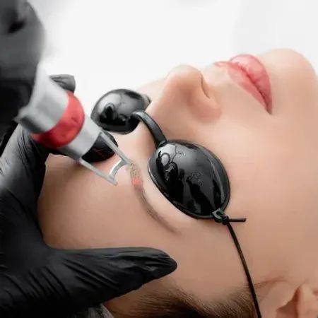 KYBROWS - Odstránenie nežiadúceho PMU